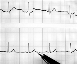 ECG