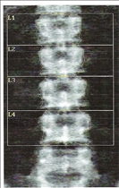 Ruptured Disc