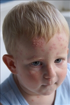 Chickenpox