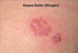 Shingles