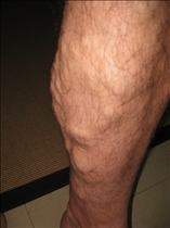 Varicose Veins