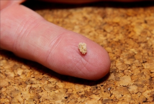 Kidney Stone